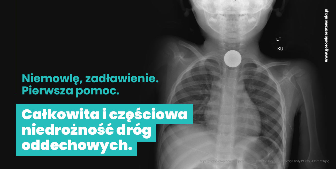 Pierwsza pomoc w zadławieniu niemowlaka